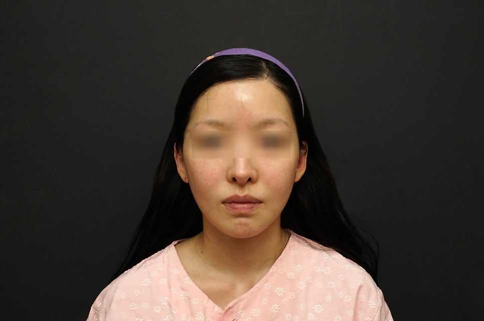 230도입체광대축소술로 재수술이 가능한 경우가 있을까요? 관련 이미지 13
