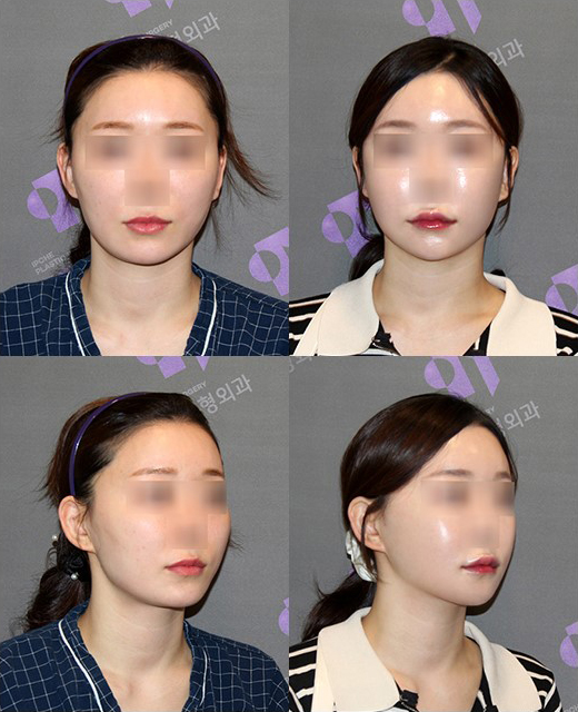 사각턱교정, 긴곡선 사각턱수술과 귀뒤사각턱의 차이와 CT분석 관련 이미지 6
