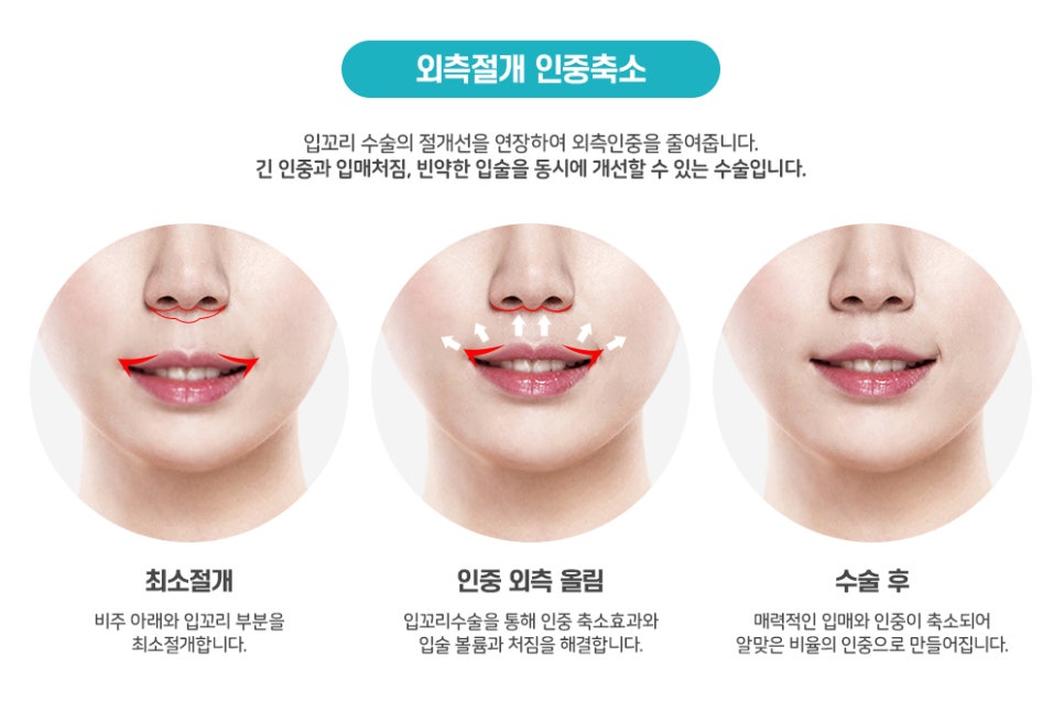 Surgery That Shortens the Midface Without Double Jaw Surgery: Philtrum Reduction Surgery image 2