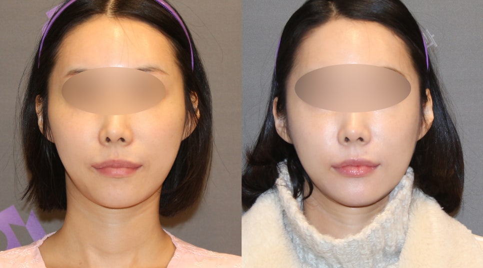 Lateral Cheekbone Reduction Surgery Review: Looking at Real Cases image 5