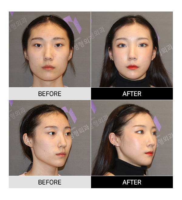 안면윤곽수술과 같이 하면 좋은 수술이 뭐가 있을까요? 관련 이미지 4