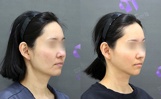 If There Is No Jaw Angle Below the Ears, Is It a “Dog Jaw”? What Is a Dog Jaw? image 8