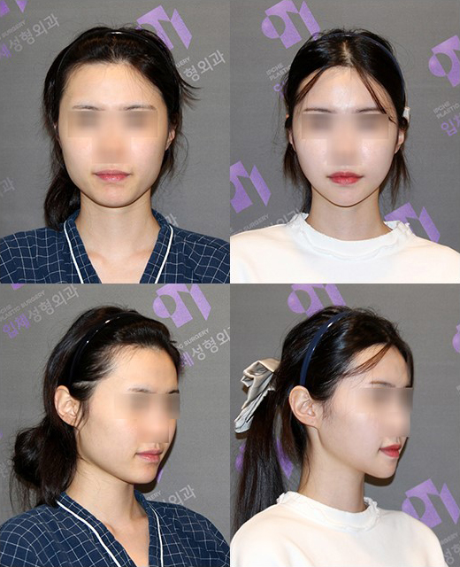 사각턱수술 정면효과에 좋은 관련 이미지 15