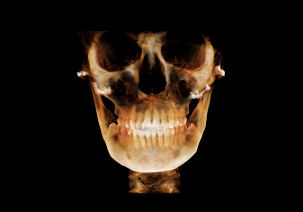 Considering revision cheekbone surgery, is it possible with a 230-degree three-dimensional cheekbone reduction as well? image 2