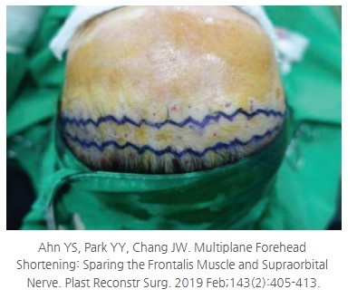 Key Techniques in Forehead Reduction Surgery - Trichophytic and W-Plasty Incisions image 5