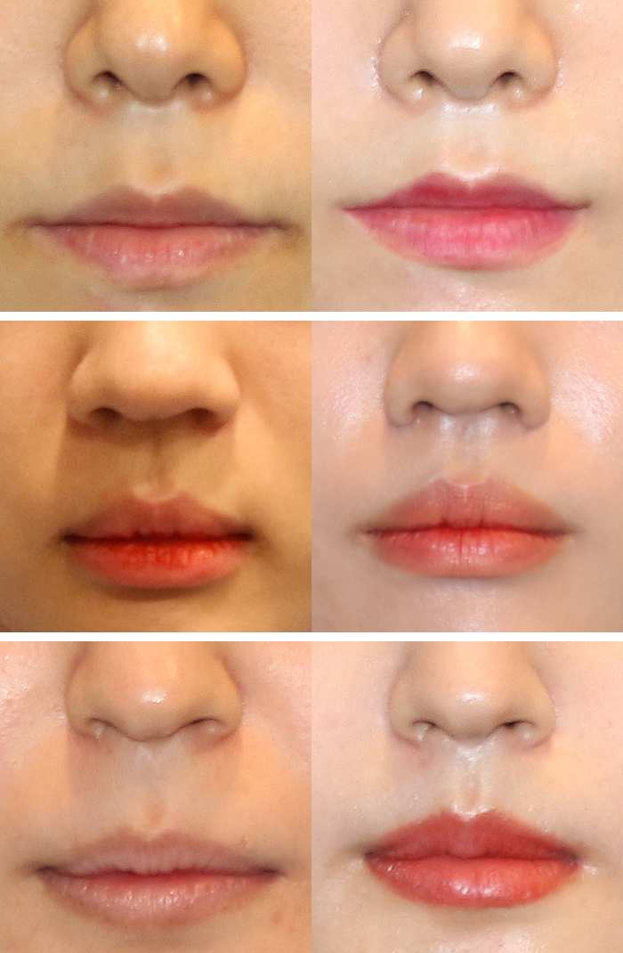 How to Adjust Long-Face Proportions: Philtrum Reduction Surgery image 5