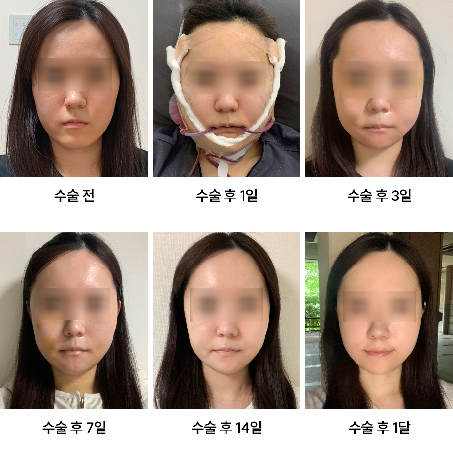 When Is Hospitalization Needed After Contouring Surgery? Warning Signs You Must Check image 3