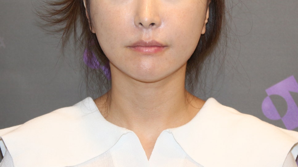 [Chin Surgery] Learning About Contouring Shave and T-Osteotomy with Real Patient Cases (2) image 15