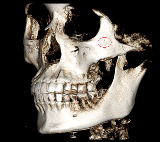 Cheek Sagging? Nonunion? Hollow Cheeks? A Complete Guide to 6 Side Effects of Zygoma Surgery image 10