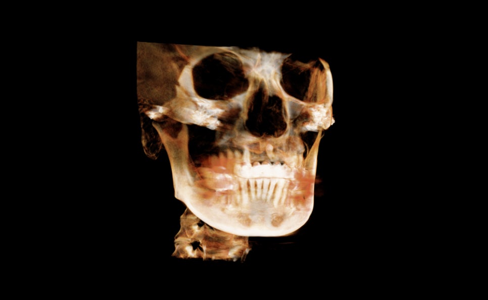 What Should Be the Top Priority in Facial Contouring Surgery: Effectiveness or Safety? image 1