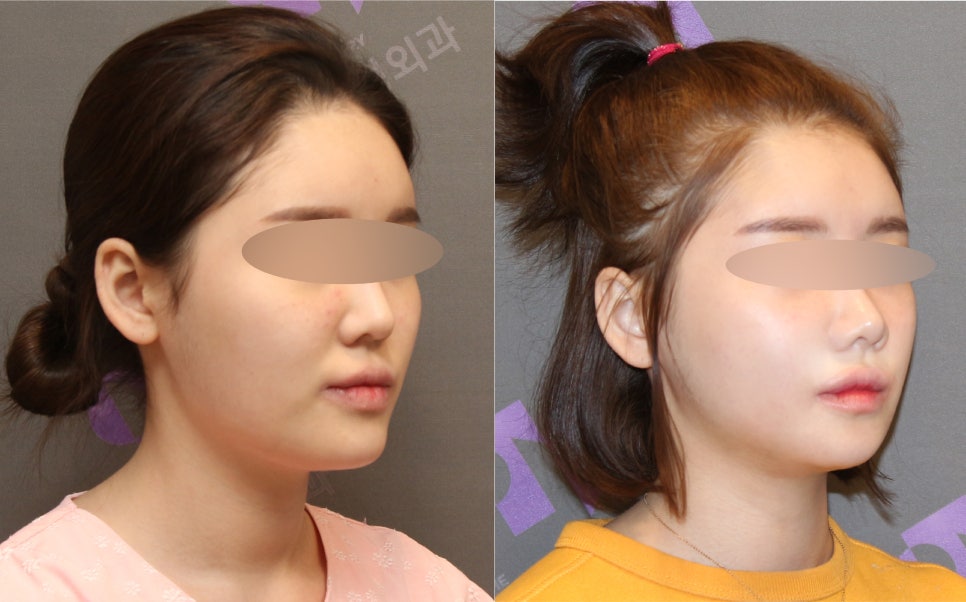 안면윤곽, 연예인 신세경처럼 예뻐질수 있을까요? -전문의가 알려드립니다. 관련 이미지 6