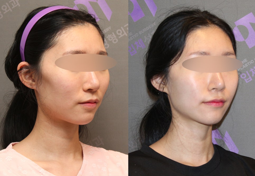 45-Degree Cheekbone Reduction Surgery Review, Let’s Look at Cases Together - Information from a Specialist image 9