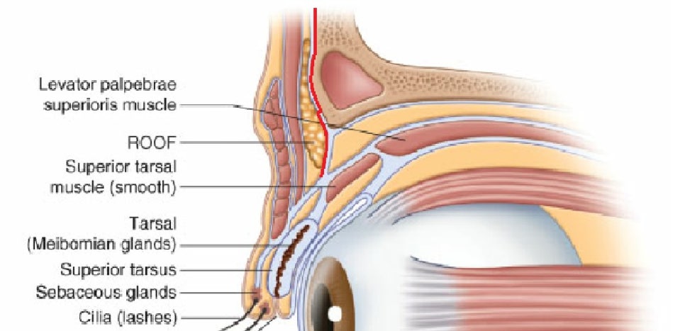 How Far Should Forehead Lift Dissection Go? Is More Fixation Always Better? image 2