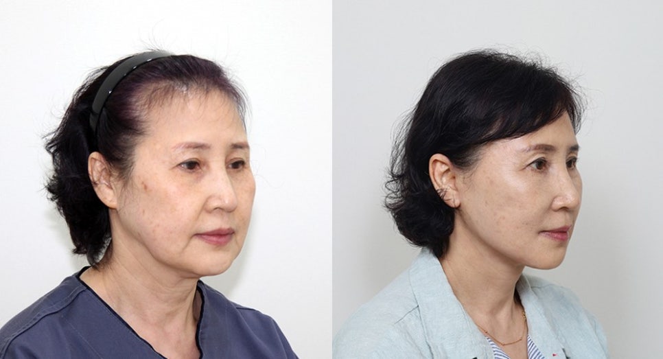 The Importance of Buccal Fat Removal in Facelift Surgery image 6