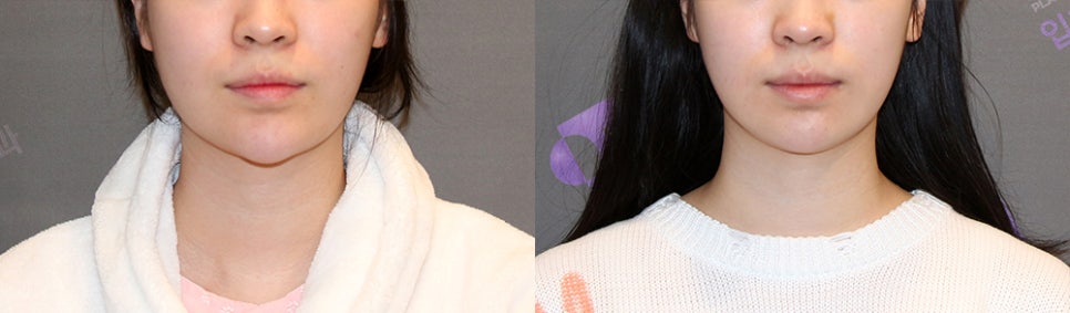 How Should Witch Chin Be Treated When You Smile? image 4