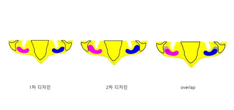 3D프린터 보형물을 이용한 안구함몰, 함몰눈 교정의 실제 사례 관련 이미지 7