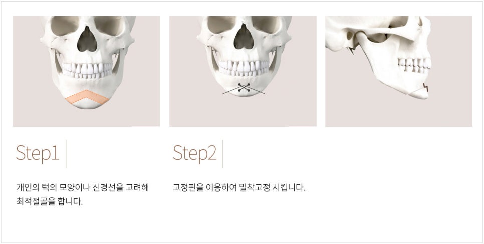 What Surgery Is Needed for a Long, Recessed Chin or a Short, Recessed Chin? image 1