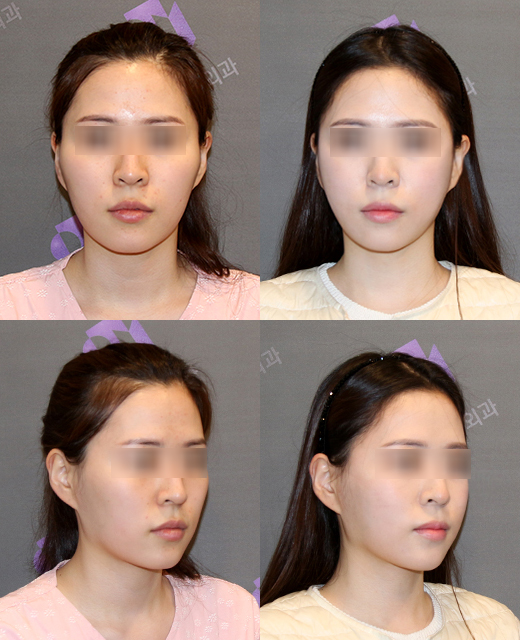 Will Zygoma Reduction Surgery Make Your Face Look Longer? - Explained by a Board-Certified Plastic Surgeon image 5