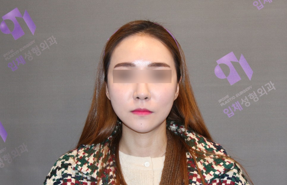 Long Chin, Long Face Contouring - Cases That Do Not Require Double Jaw Surgery image 7