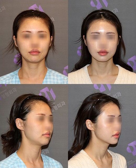 Is it good to combine facial contouring surgery with buccal fat removal? image 2
