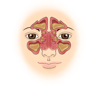 Cheek Sagging? Nonunion? Hollow Cheeks? A Complete Guide to 6 Side Effects of Zygoma Surgery image 12