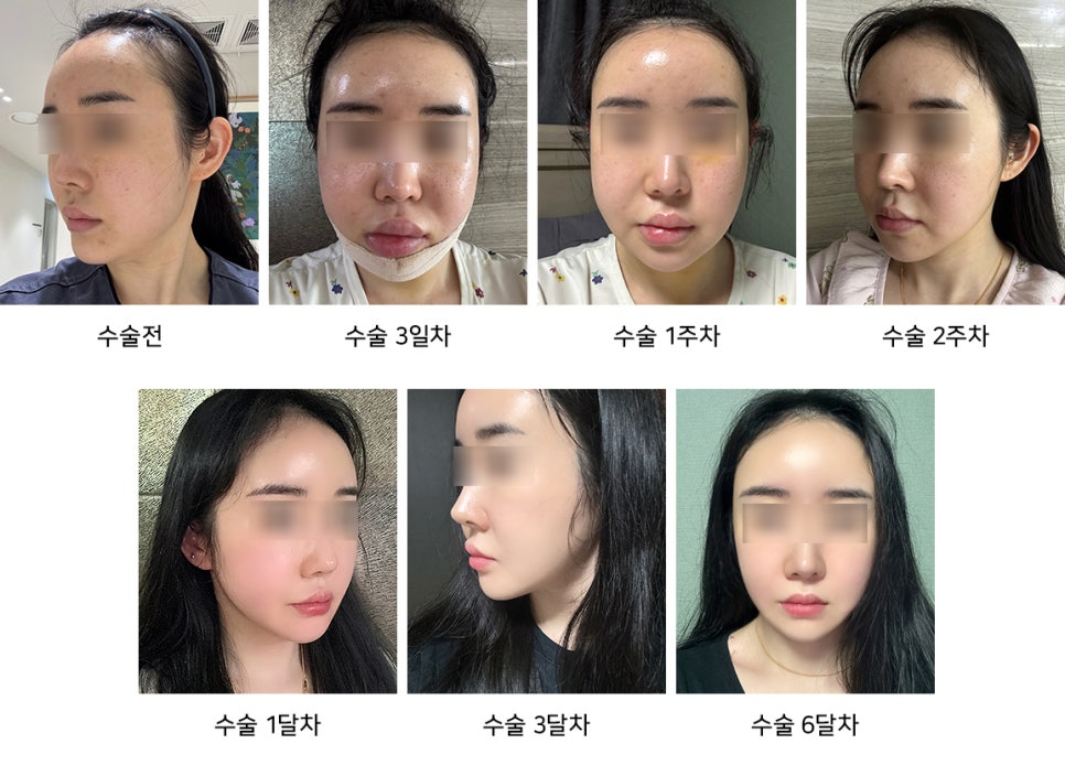 The Real Cause of What Feels Like Cheek Sagging After Contouring Surgery image 1