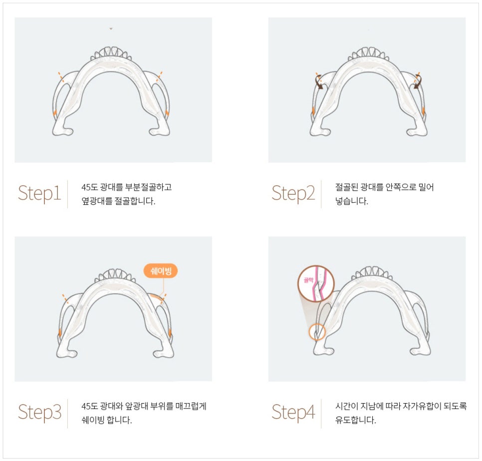 Is facial contouring surgery possible even at an older age? Important things you should know image 9