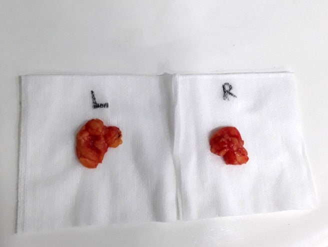 Is it good to combine facial contouring surgery with buccal fat removal? image 5