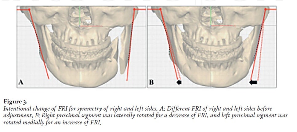 [Paper Review] Technological Advances and Real-World Applications in Modern Facial Contouring Surgery: Correction of Facial Asymmetry image 4