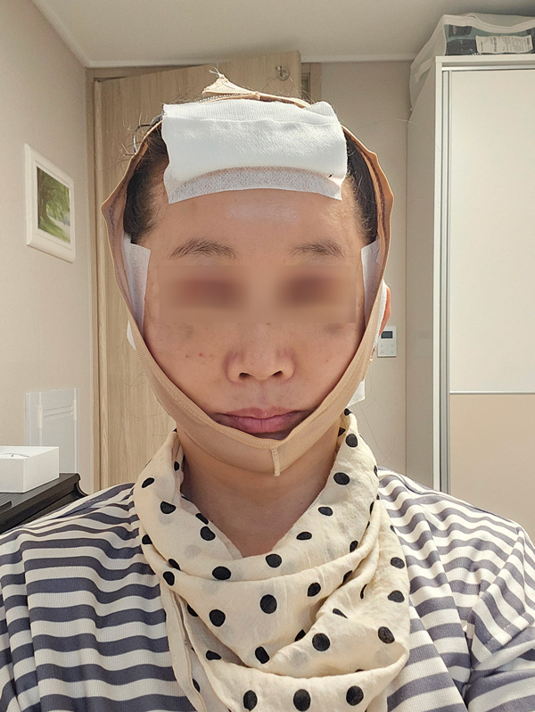 Facelift Recovery Period: When Will My Face Look Natural Again? image 1