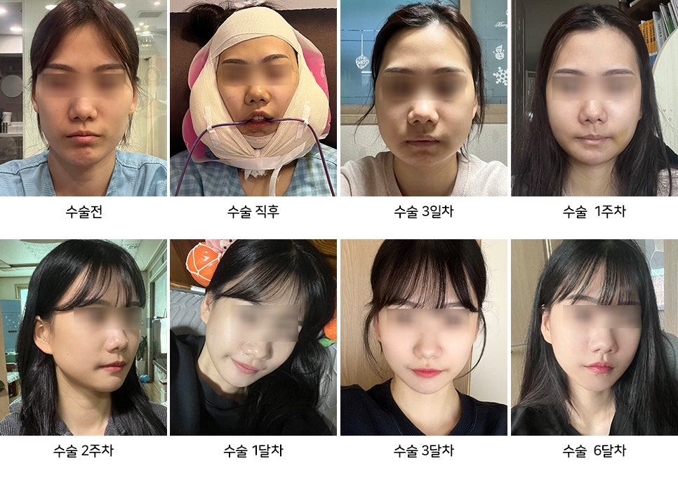 윤곽수술 후 피주머니 꼭 착용해야 하나요? 관련 이미지 5