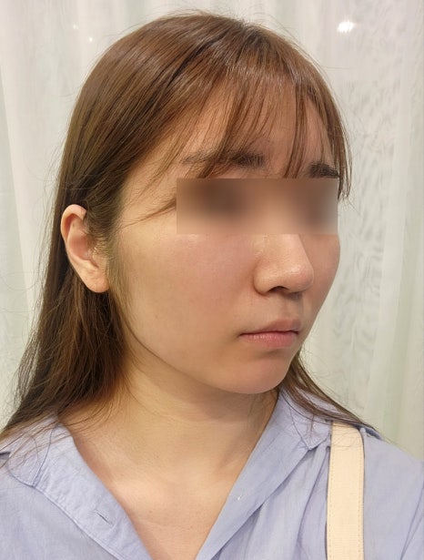 땅콩형얼굴 윤곽수술로 해결할 수 있을까요? 관련 이미지 2
