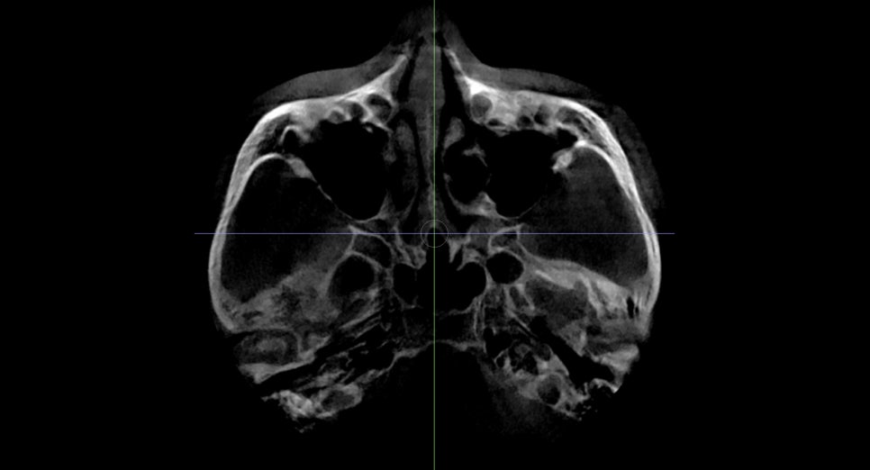 I had cheekbone surgery, but the back cheekbone remains. Is there a way to fix it? image 4