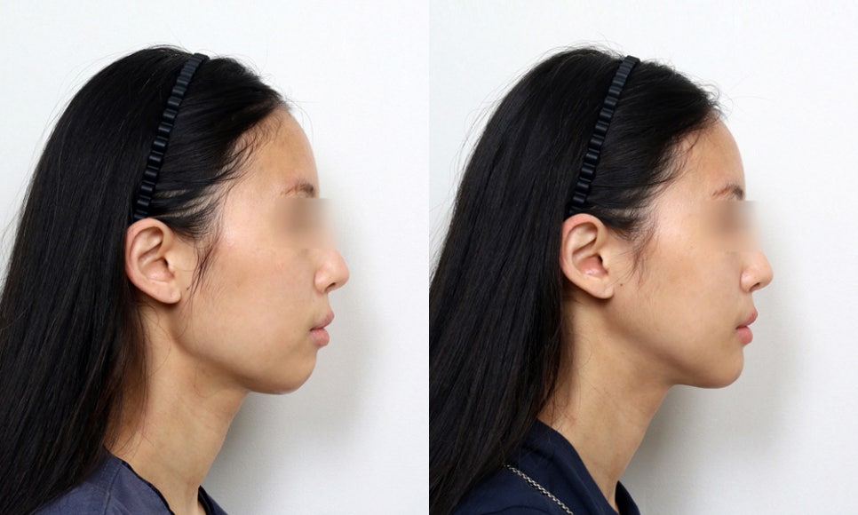 What Surgery Is Best for Correcting a Short Chin or Recessed Chin? The Limits of Chin Surgery and the Actual Results image 3