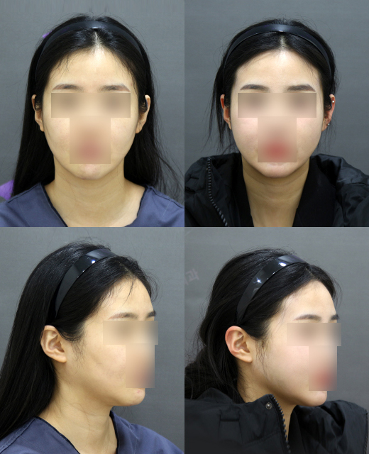 How effective is the incision method compared to the non-incision method for cheek hollow correction? image 6