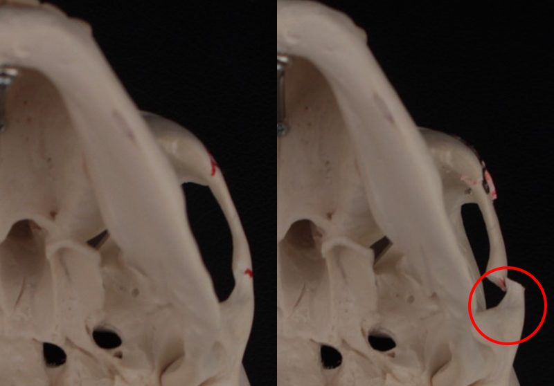 After cheekbone reduction surgery, is there still a back cheekbone left? Is there a solution? image 1