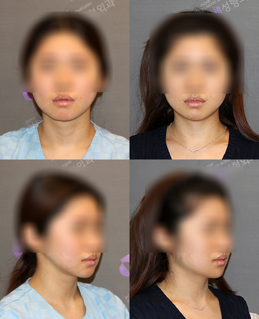 Jaw Contour Surgery: Why Is Revision Surgery Performed? image 8