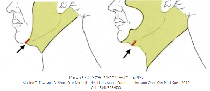 The 4-Step Secret of Double Chin Soft Contouring (Submental Lift): From Incision to Muscle Tightening image 1