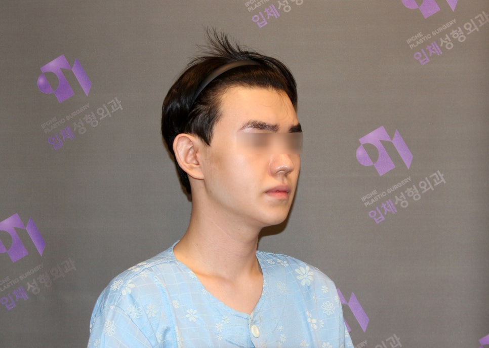 230도입체광대축소술로 재수술이 가능한 경우가 있을까요? 관련 이미지 7