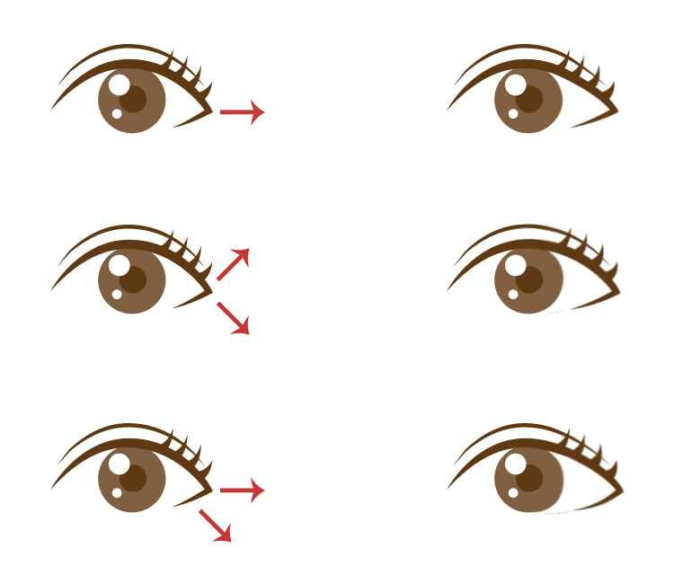 Surgery That Goes Well with Cheekbone Surgery, Part 1: Lateral and Lower Canthoplasty image 3