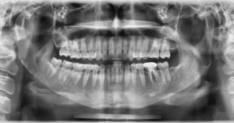 Jaw Contour Surgery: Why Is Revision Surgery Performed? image 4