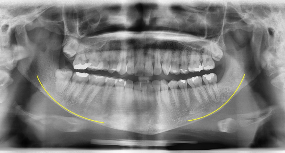 What Should Be the Top Priority in Facial Contouring Surgery: Effectiveness or Safety? image 4