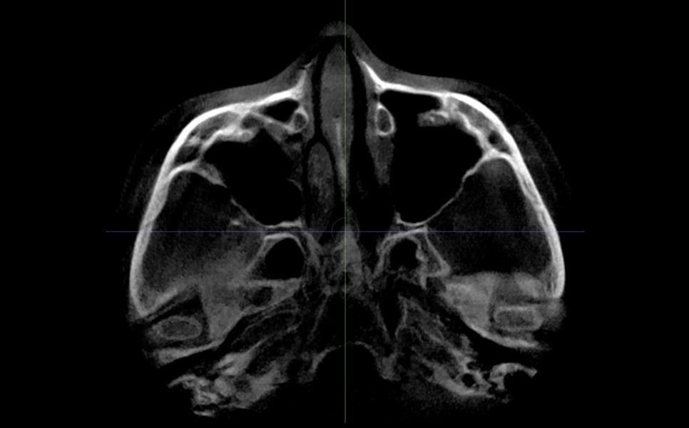 Cheek Sagging? Nonunion? Hollow Cheeks? A Complete Guide to 6 Side Effects of Zygoma Surgery image 7