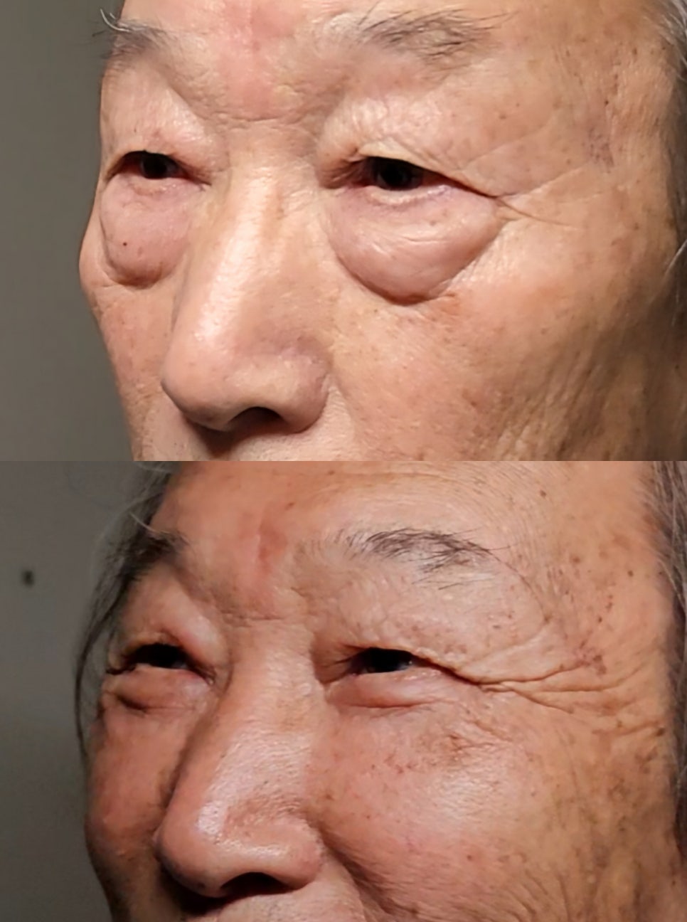 The Evolution of Fourth-Generation Lower Blepharoplasty - Midface Lift (Cheek Lift) and Apple Cheeks image 3
