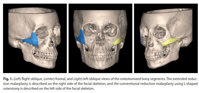 [Paper Review] The Extended Zygoma Reduction Surgery Recently in Vogue in Japan image 3