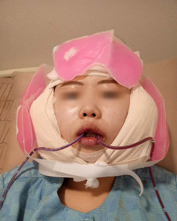 안면윤곽수술 후 피주머니 피통 꼭 착용해야 하나요? 관련 이미지 1