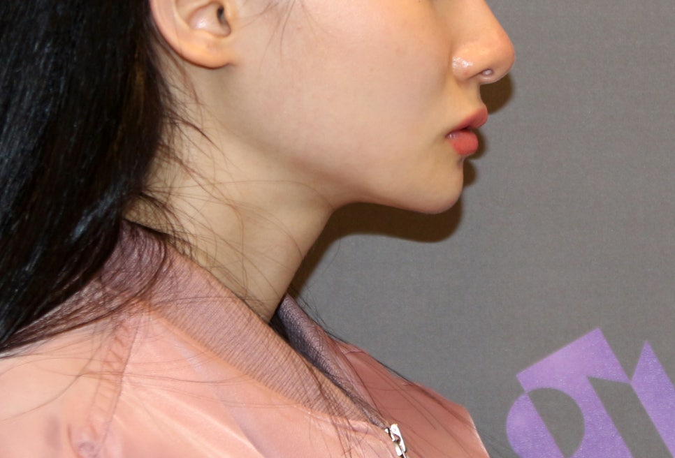 턱끝수술부작용, 이중턱이 생기는 이유는? - 전문의가 알려드립니다. 관련 이미지 5