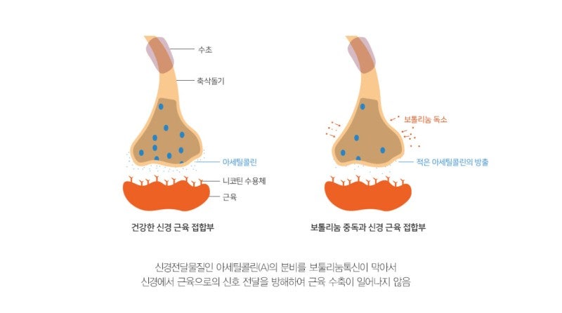 About Masseter Reduction Surgery for Improving the Frontal Effect of the Lower Face image 2