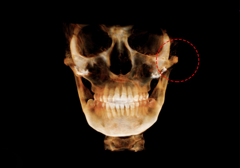Considering revision cheekbone surgery, is it possible with a 230-degree three-dimensional cheekbone reduction as well? image 1