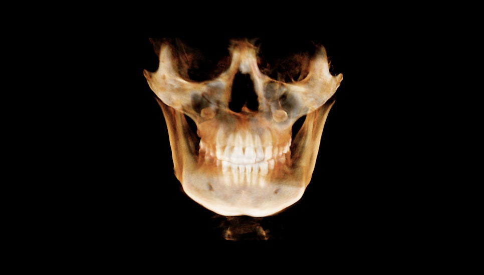 Why Is Male Cheekbone Reduction Different from Female Cheekbone Reduction? image 3